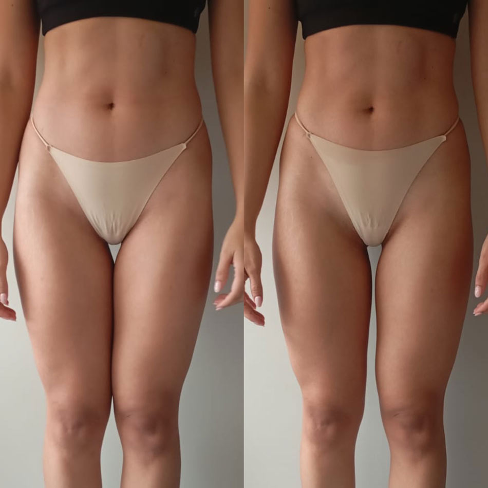 drenaje linfatico guatemala