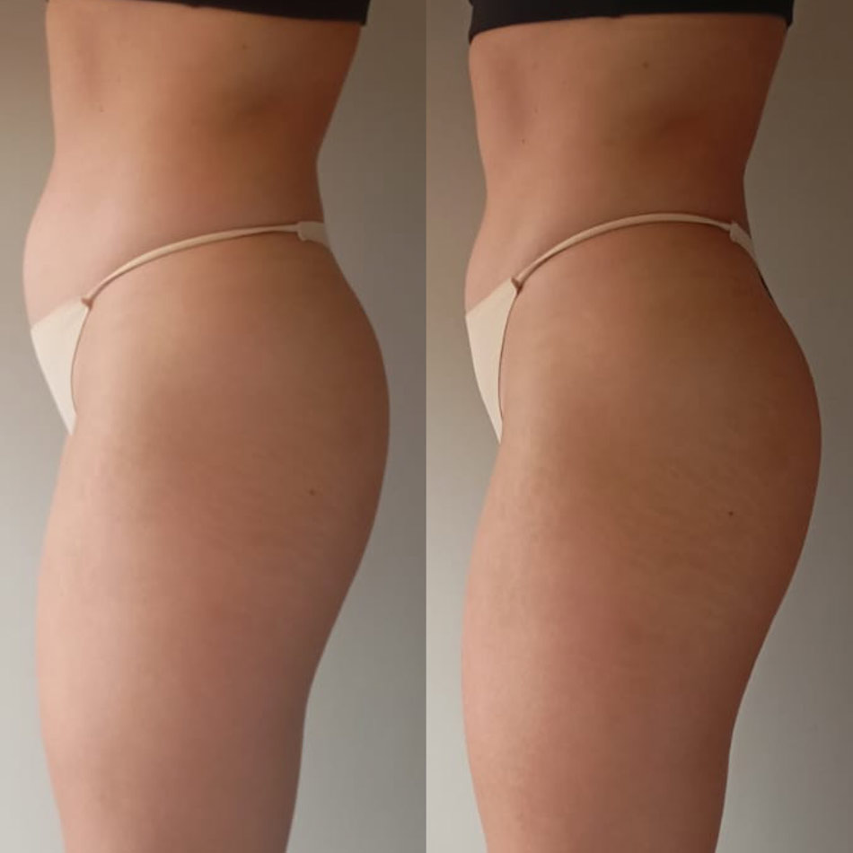 drenaje linfatico guatemala