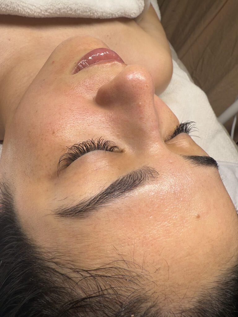 microagujas guatemala