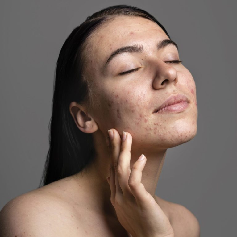 retrato-de-mujer-joven-confiado-con-acne